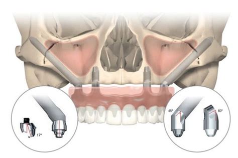 Zygoma Implants | Jussmile Dental Clinic Chennai