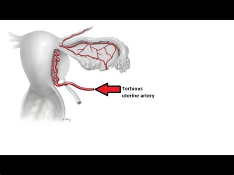 Mastering Uterine Artery Anatomy A Concise Summary Included Youtube