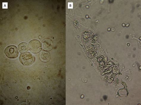 Urine Sediment Examination In The Diagnosis And Management Of Kidney