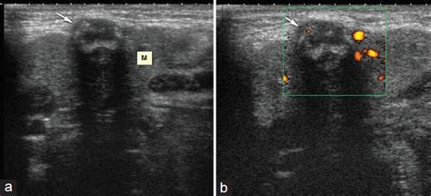 Ultrasound And Doppler Us In Evaluation Of Superficial Soft Tissue