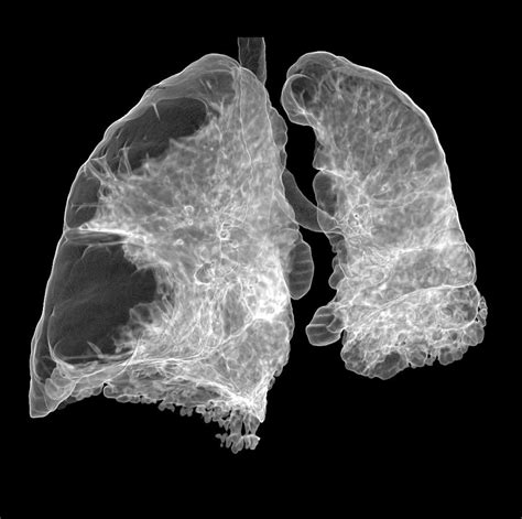 Copd Lung Ct Scan