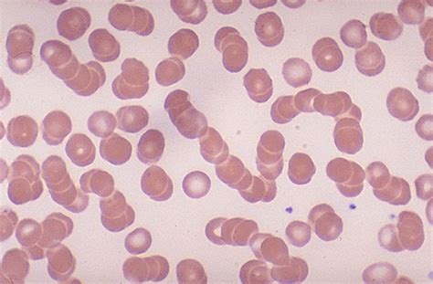 Rouleaux Formation blood smear | Medical Laboratories