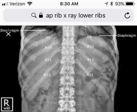 Ap Lower Ribs Used To Visualize Posterior Ribs Ribs X Ray Visual