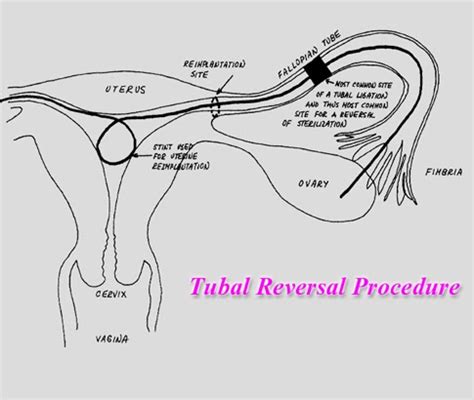 Tubal Ligation Reversal: Tubal Ligation Reversal