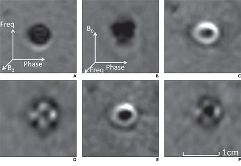 Figure From Comparison Of The Artifacts Caused By Metallic Implants