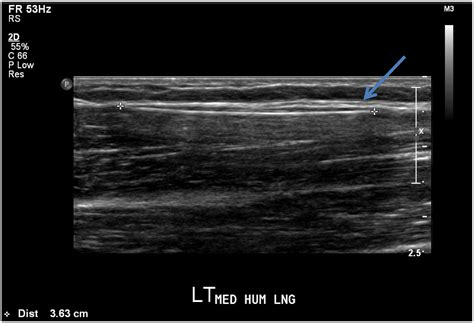 Removal Of A Nexplanon® Implant Located In The Biceps Muscle Using A Combination Of Ultrasound