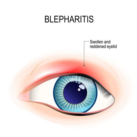 Blepharitis - Health BeatHealth Beat