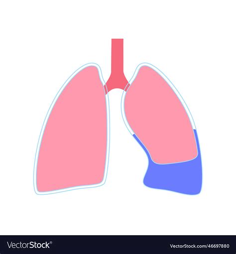 Pleural Effusion Poster Royalty Free Vector Image