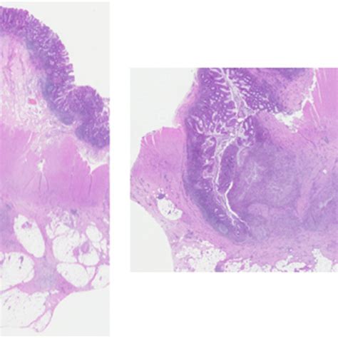 Diverticulities with peridiverticular abscess formation; H&E stain A)... | Download Scientific ...