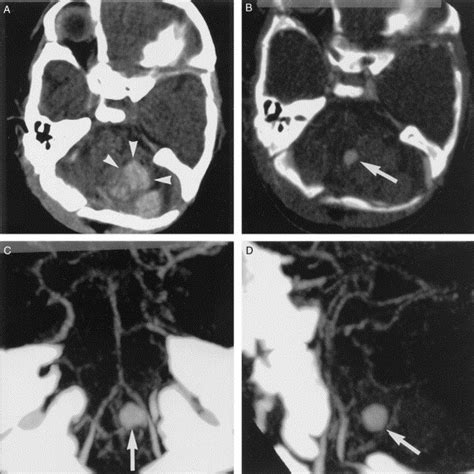 Aneurysm Detection With Computed Tomographic Angiography In A 1 Month