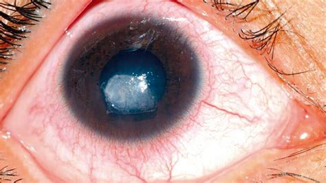 Corneal Ulcer Keratitis Symptoms Causes Treatment