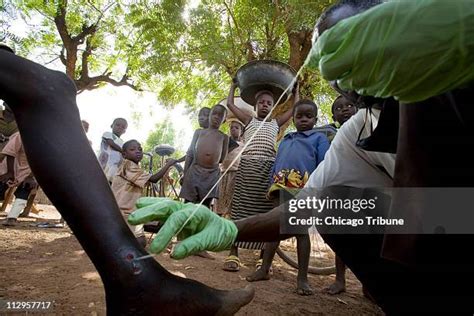 110 Guinea Worm Stock Photos, High-Res Pictures, and Images - Getty Images