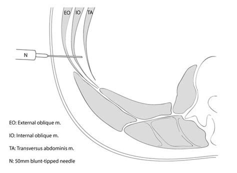 obstetric anesthesia iiih  tap blocks ultrasound abdominal wall