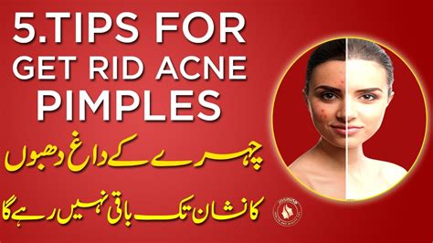 5 Tips For Pimples And Acne Treatment Skin Care Rang Gora Karne Ka