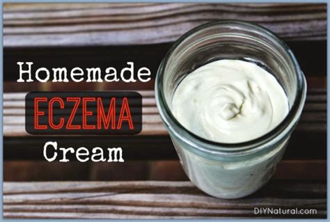 Homemade Eczema Cream: A Natural Solution That Works!