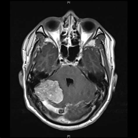 Axial T1 T2 Weighted With Without Contrast MRI Brain At Initial