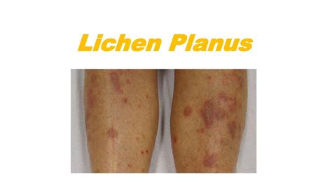 Ppt Lichen Planus Complete Knowledge Powerpoint Presentation Free