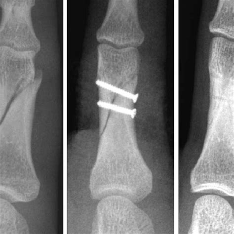 Great Toe Proximal Phalanx Fracture