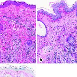 Punch Biopsy Of The Right Cheek A Mediumpower View Of H E Stain