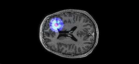 Quantum Technology For Cancer Imaging