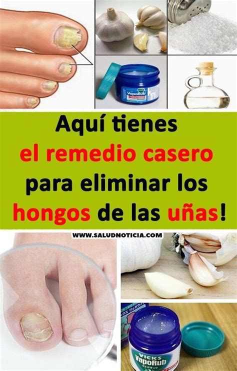 5 Remedios Para Los Hongos En Las Uñas En 2020 F28