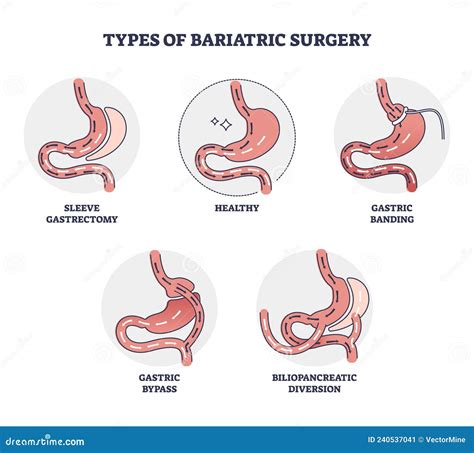 Tipos De Cirurgia Bari Trica E Diagrama Esquem Tico De Controlo Da