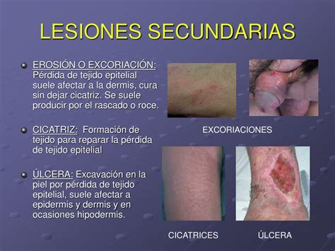 Lesiones Secundarias