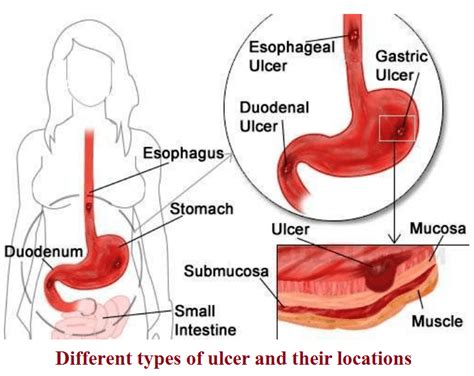 Peptic Ulcer पेट में अल्सर छाले