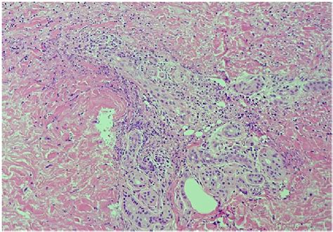 Pathological Finding Hematoxylin Eosin Stain Of The Skin Showing