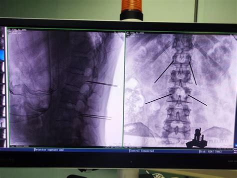 Percutaneous Pedicle Screw Fixation Assisted With Perlove Medicals