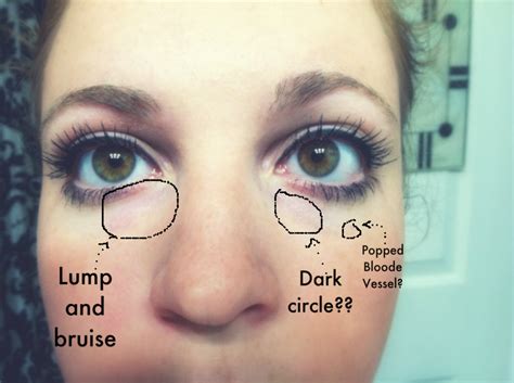 Eye Symptoms: Symptoms Of Popped Blood Vessel In Eye