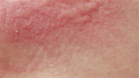 What Is Dermatitis Causes Treatments And Advice For Irritated Skin