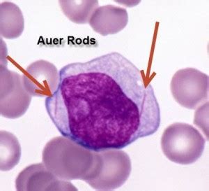 Auer Rods in malignant cells | Medical Laboratories