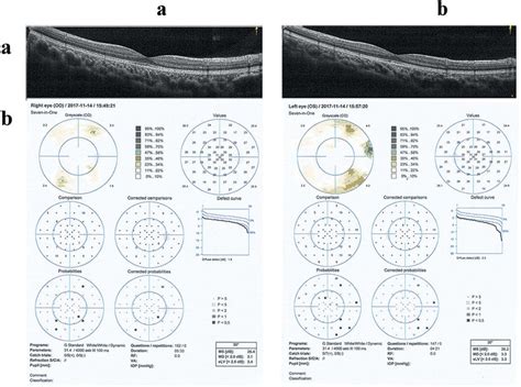 Optical Coherence Tomography OCT And Octopus Static Perimetry