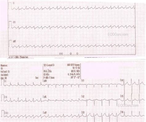 Ventricular Flutter ECG