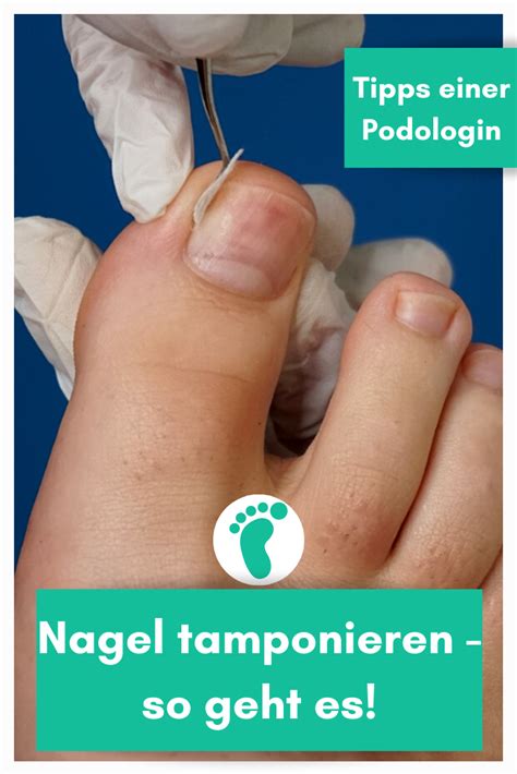 Nagel tamponieren so geht es Nägel Zehennägel eingewachsene