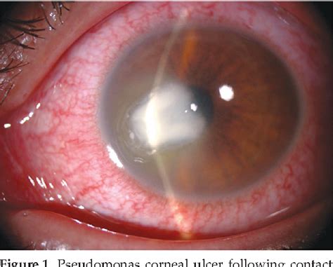 Corneal Ulcer Contact Lens