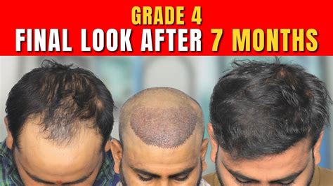 Fue Hair Transplant Results Qht Fue Hair Transplant Nw Grade 4 A Qht Clinic Youtube