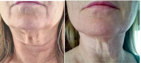 Best Treatment For Sagging Neck And Jowls Get More Anythink S