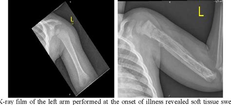 Figure 1 From Salmonella Sepsis And Osteomyelitis In Sickle Cell