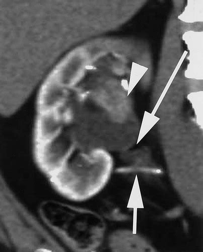 Adult Ureteropelvic Junction Obstruction Insights With Three Dimensional Multi Detector Row Ct