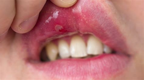 Canker Sore Puffy Lip