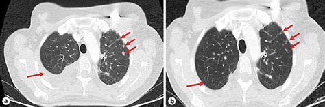 CT Of The Thorax Arrows Indicate Pleural Effusion And Lung Metastases