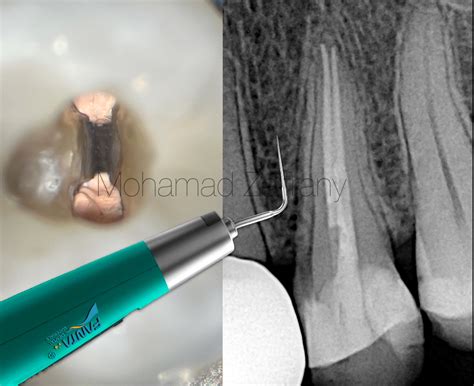 Bioceramics & Heat: The Possible Couple - Style Italiano Endodontics