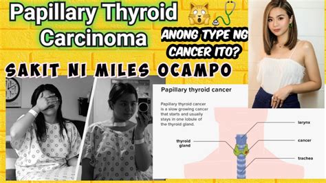 Sakit Ni Miles Ocampo Papillary Thyroid Carcinoma Ano Ang Sakit Na