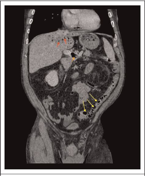 Figure From Portal Venous Gas As A Radiological Sign In A Sigmoid