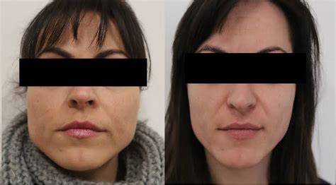 How Long Does Masseter Botox Take To Work Rectangle Circle