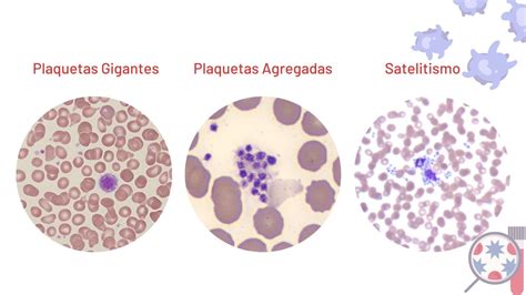 Plaquetas Alteradas O Que Significa - O que significa plaquetas baixas no sangue?