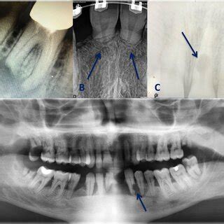 Types of tooth root resorption. | Download Scientific Diagram