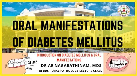 Diabetes Mellitus Oral Manifestations And Dental Considerations YouTube